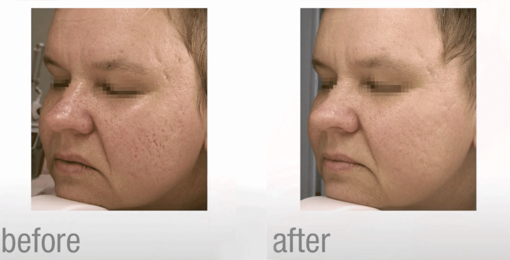 Resurfa Age Fractionn Au Laser Femmes M Dispa Physimed