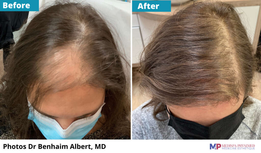 Prp For Hair Loss Women S Aesthetics Medispa Physimed