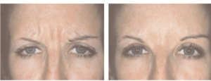 botox injections before and after