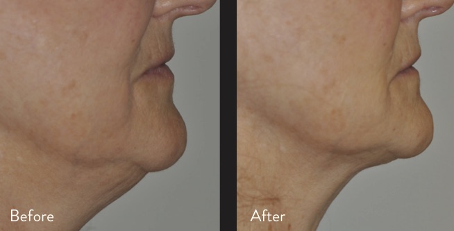 nonsurgical facelift