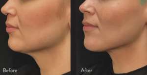 nonsurgical facelift cost