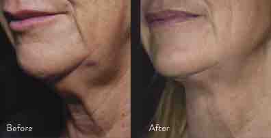 nonsurgical facelift cost