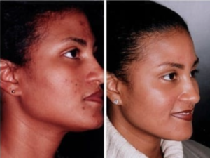 chemical peel for acne