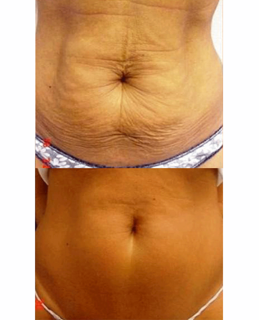 Pamper Me - Our Nannic tummy tightening is a clinically proven non-invasive  treatment designed to reduce sagging and tighten the skin on the abdomen.  Loose abdominal skin can occur for several reasons