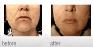 laser for skin resurfacing