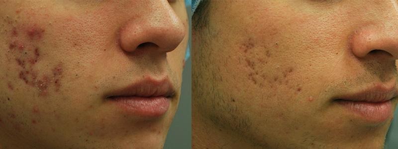 laser treatment for acne