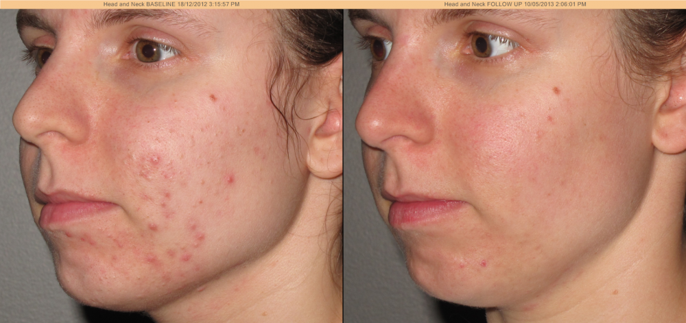 laser treatment for acne