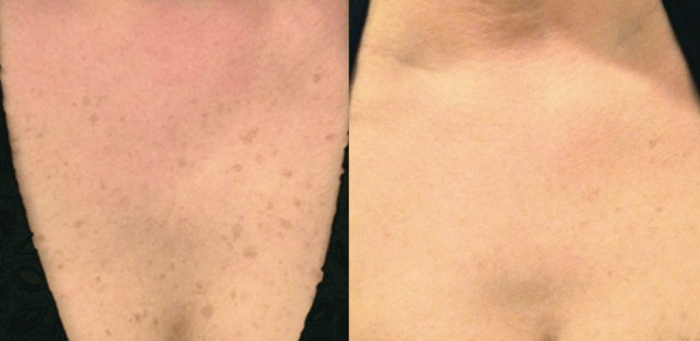 sun spots on chest