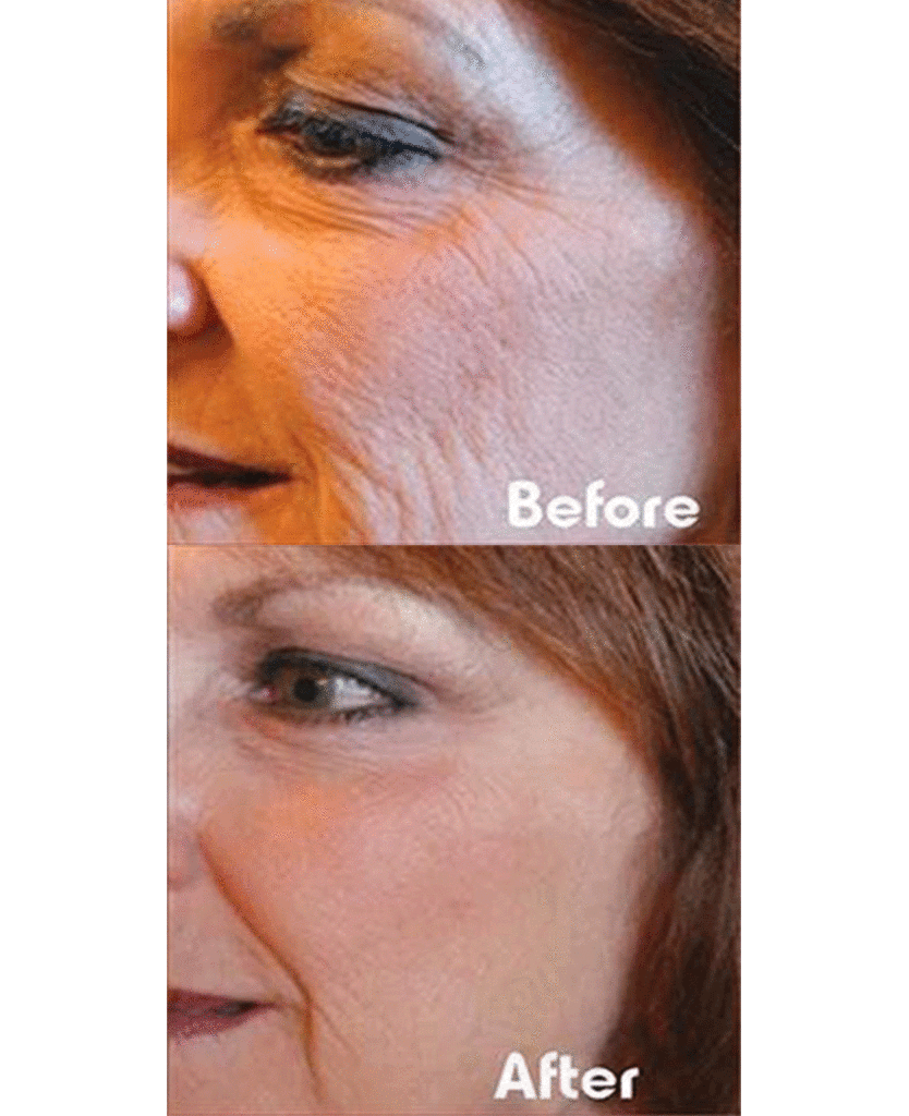 Resurfacing laser for scar removal and wrinkles, Men