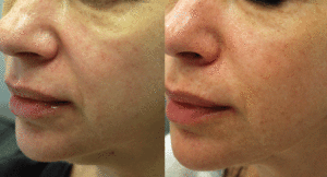 nonsurgical facelift