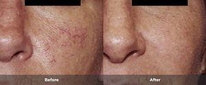 laser treatment for rosacea