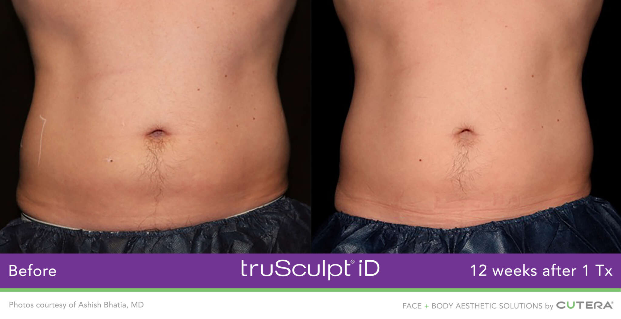 Non invasive fat removal with TruSculpt iD Men Medispa Physimed