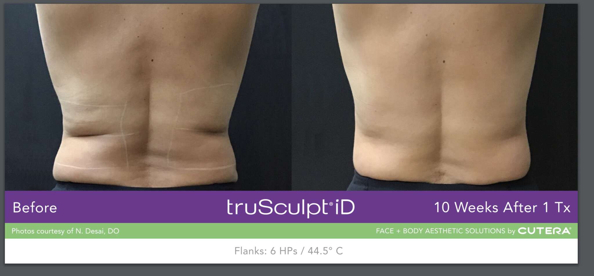 Non invasive fat removal with TruSculpt iD Men Medispa Physimed