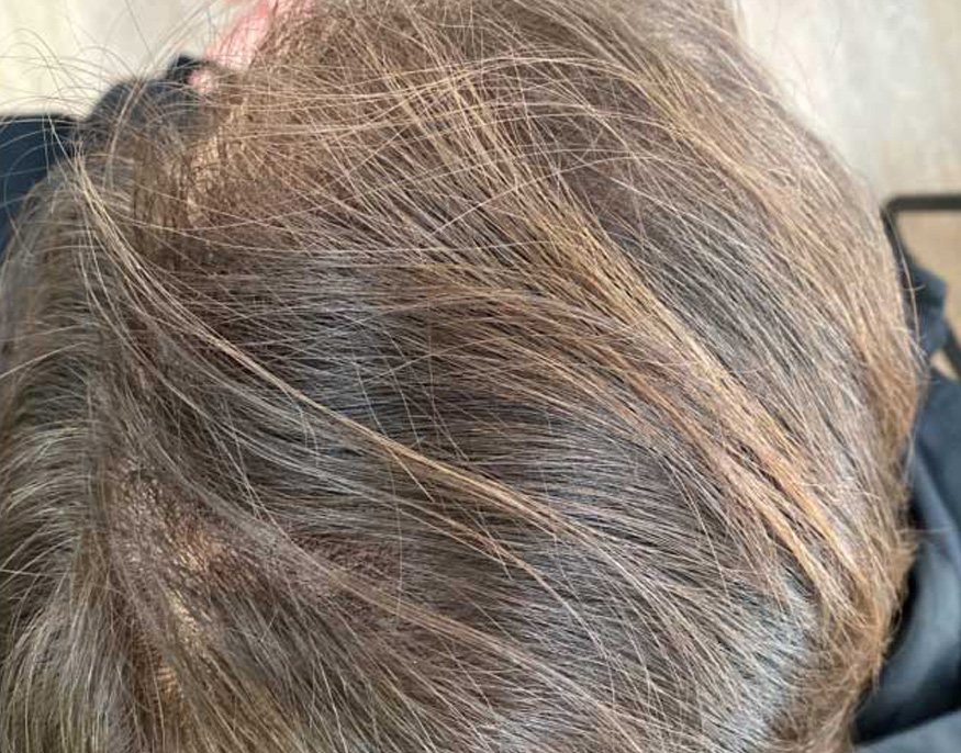 Skin tightening — After