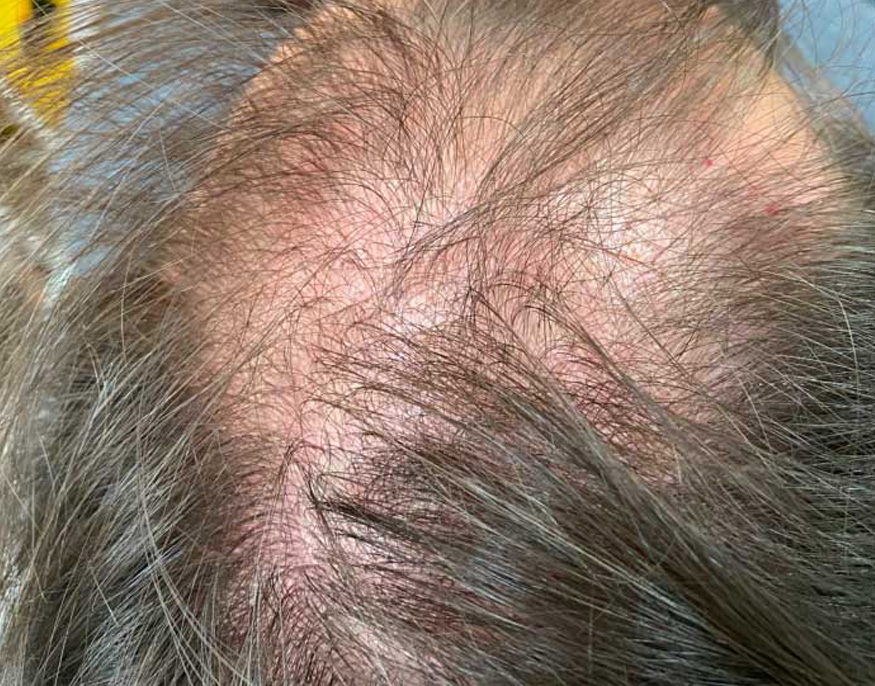 Skin tightening — Before