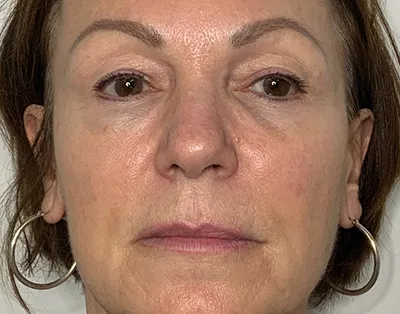 Raffermissement de la peau — Après